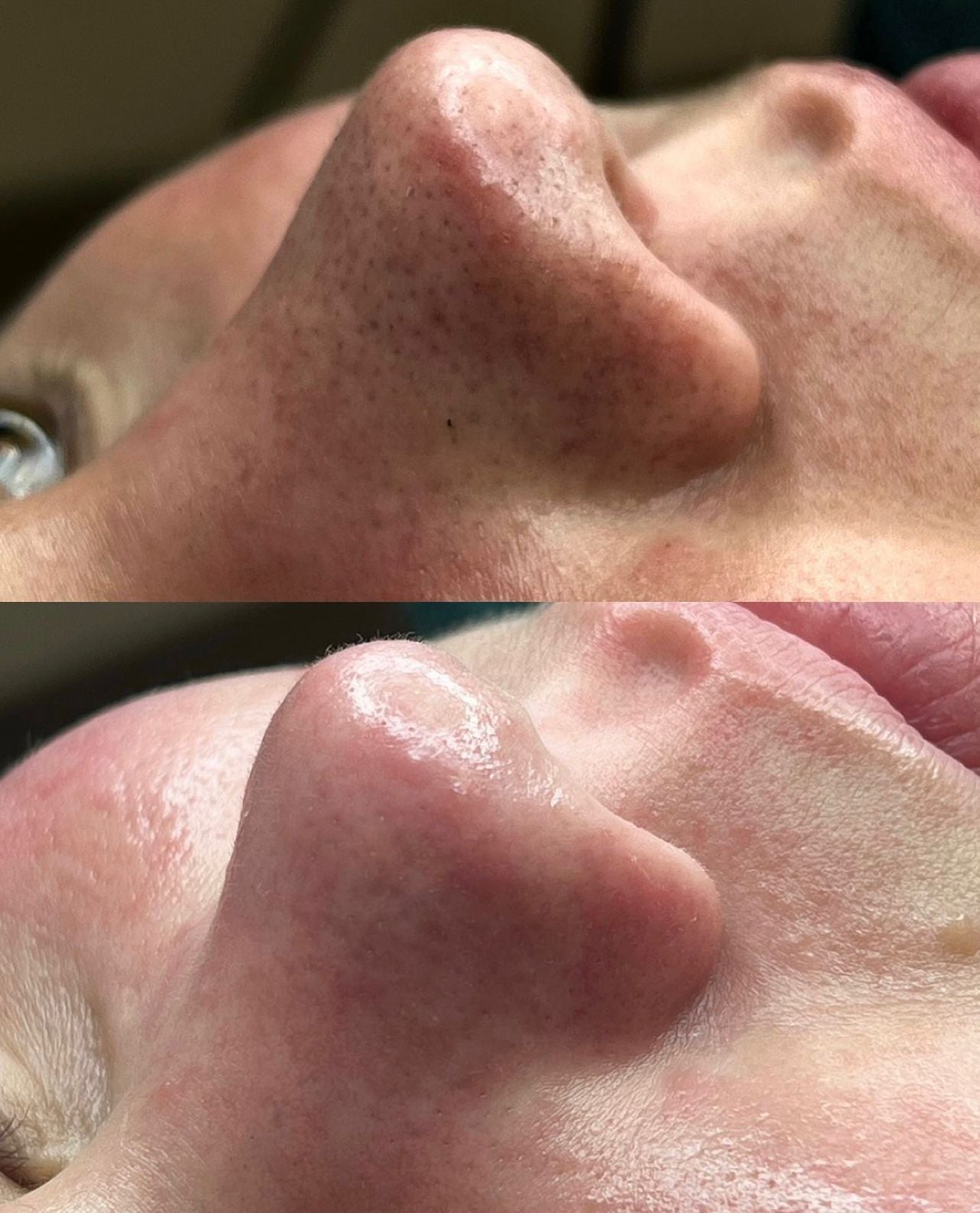Limpiador Ultrasonico Facial