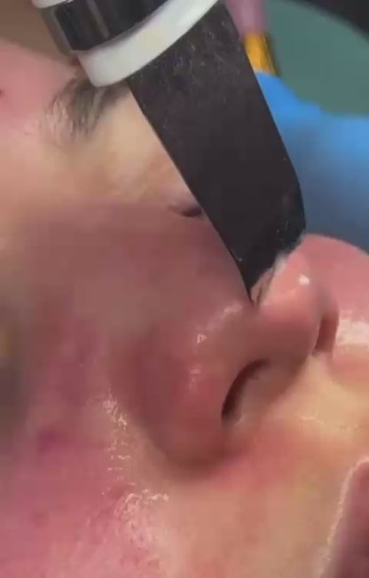 UltraScrub - Espátula Ultrasónica Facial