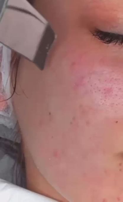 UltraScrub - Espátula Ultrasónica Facial